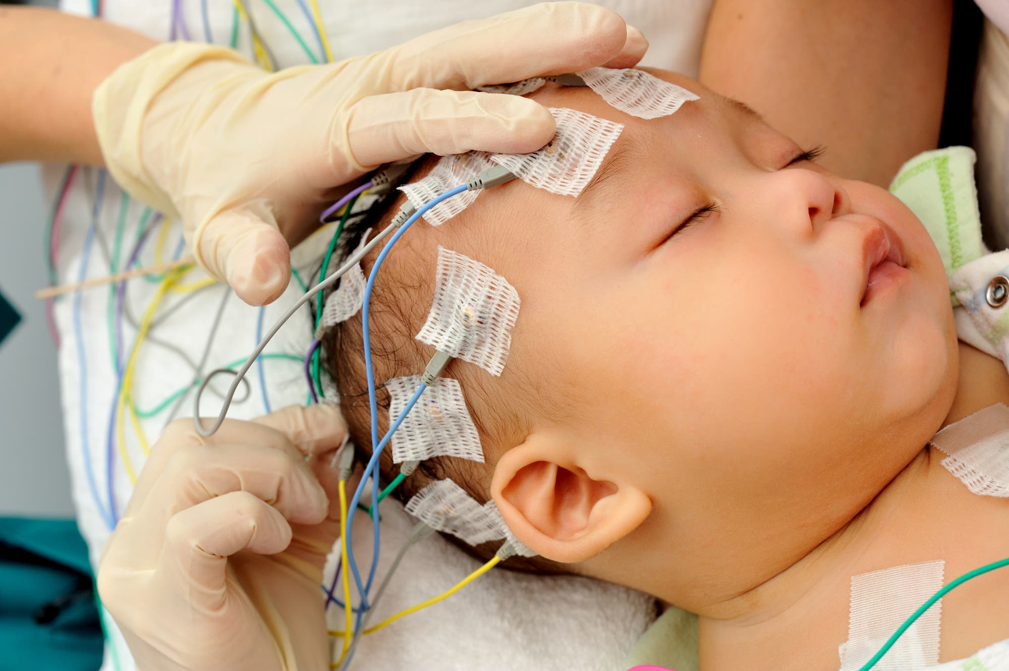 Ein Baby liegt mit geschlossenen Augen auf einer Liege, während eine medizinische Fachkraft mit Handschuhen Elektroden an seinem Kopf befestigt. Die Elektroden sind mit farbigen Kabeln verbunden, die für ein EEG (Elektroenzephalogramm) verwendet werden. Die Szene vermittelt den Eindruck einer medizinischen Untersuchung oder Diagnose.