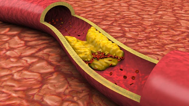 Hohe Cholesterinspiegel verursachen Arteriosklerose - oder?