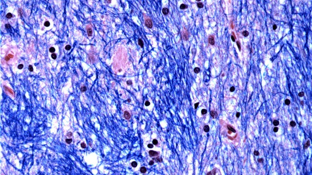 Mikroskopische Aufnahme eines angefärbten Hirngewebeschnitts  aus dem Nucleus caudatus