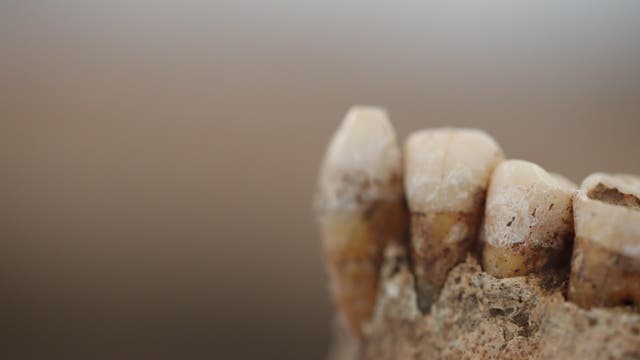 Ein Kieferfragment aus Italien mit Zahnstein